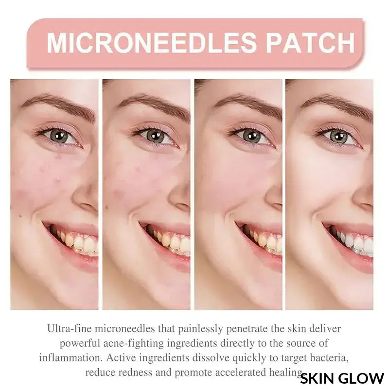 Microneedle patch showing progressive skin improvement in four stages for Pimple Patch Invisible